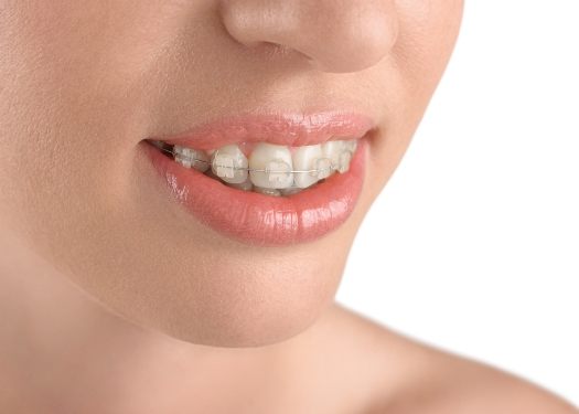 Closeup of smile with clear braces