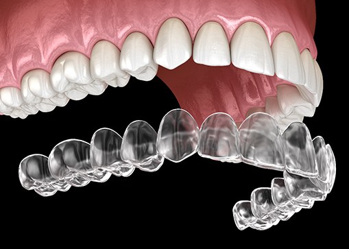 3 D illustration of clear aligner being placed over upper teeth