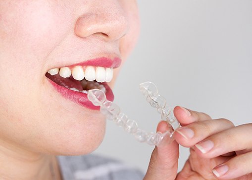 woman taking clear aligner out of her mouth