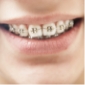 Closeup of smile with traditional braces