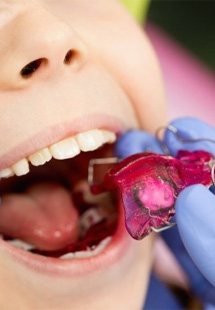 Orthodontist placing a retainer