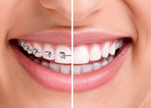 Closeup of smile during and after orthodontic treatment