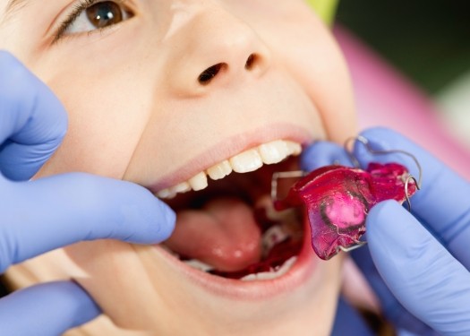 Orthodontist placing a retainer in the mouth of a child patient