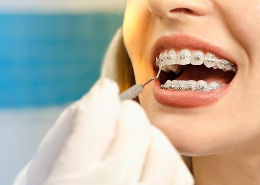 dentist giving dental exam to a patient with braces