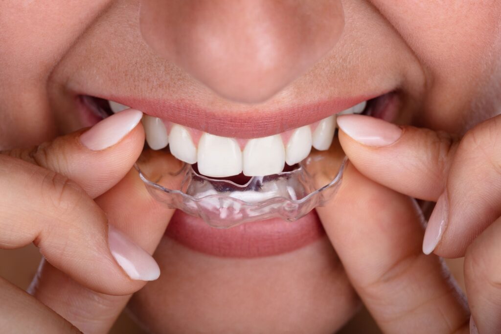 Closeup of someone putting clear aligners over their upper arch